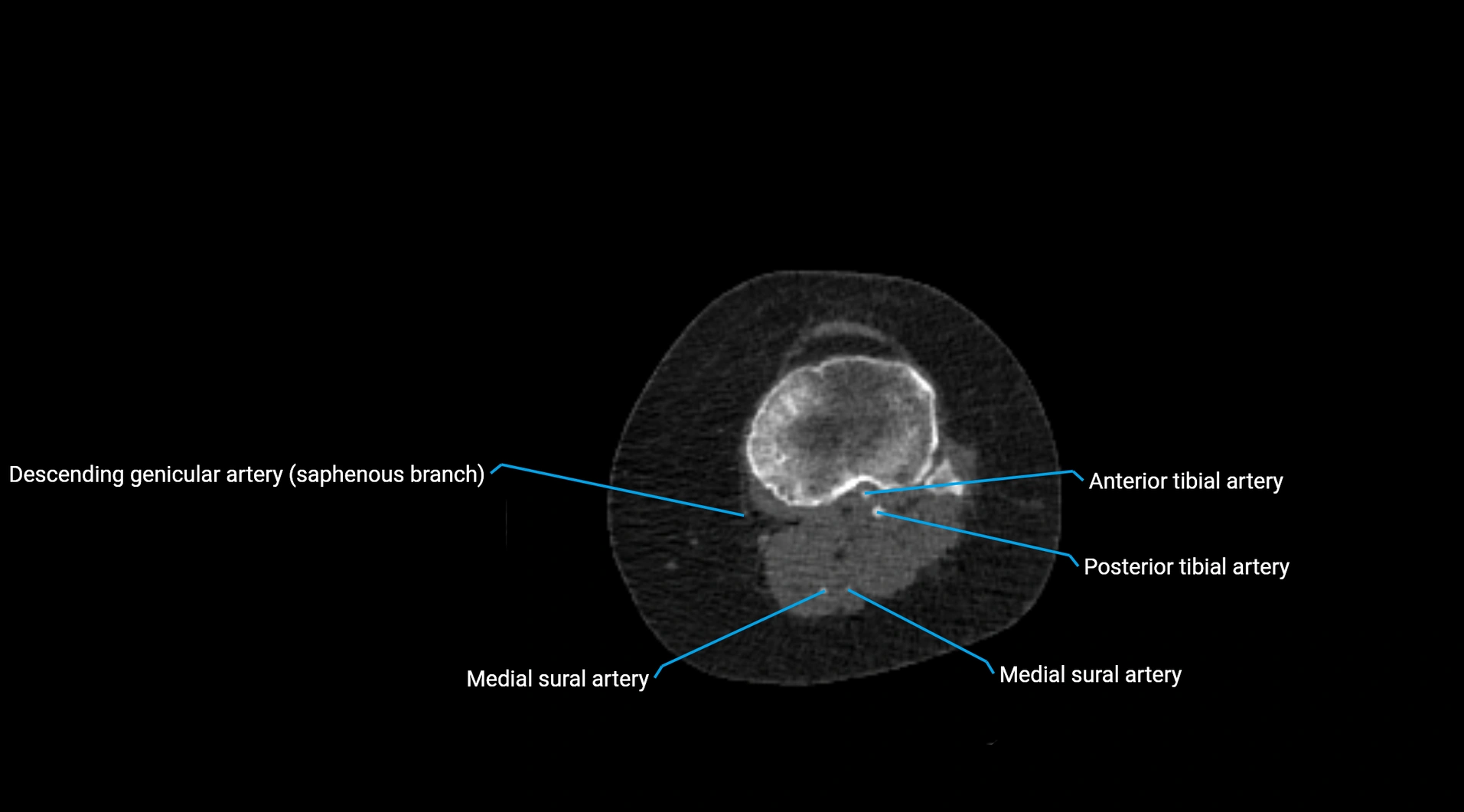 CTA lower limb cross sectional anatomy labelled image _180 - Copy.webp